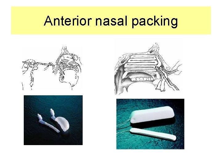 Anterior nasal packing 