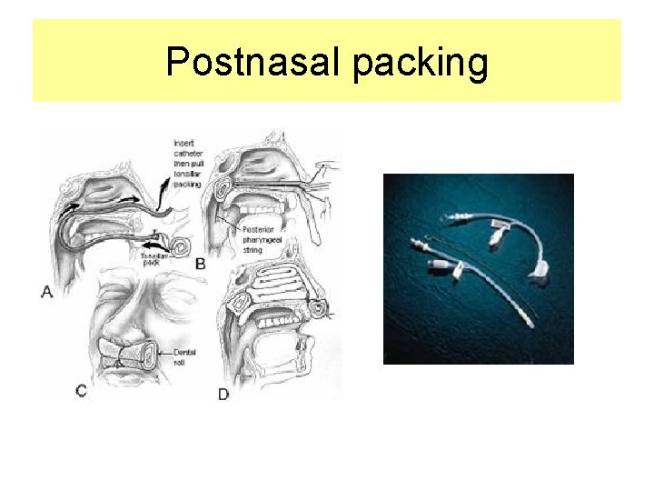 Postnasal packing 