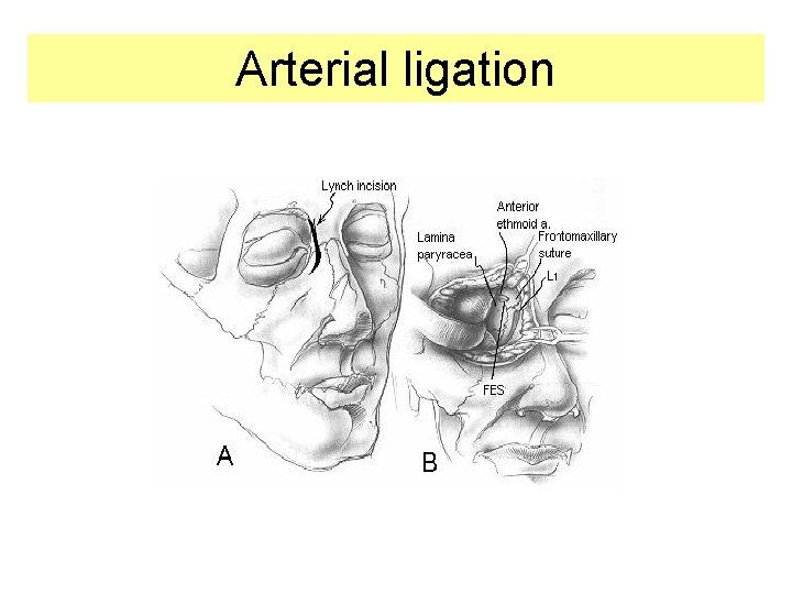 Arterial ligation 