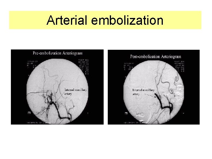 Arterial embolization 