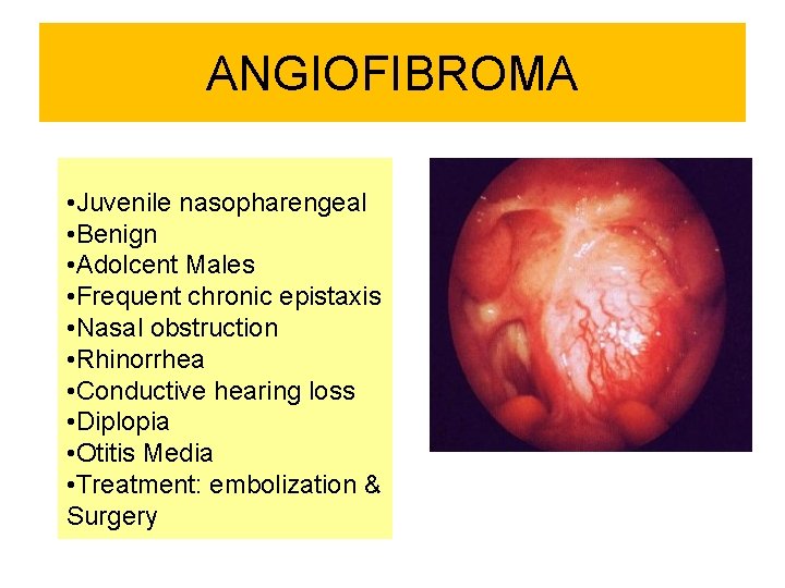 ANGIOFIBROMA • Juvenile nasopharengeal • Benign • Adolcent Males • Frequent chronic epistaxis •