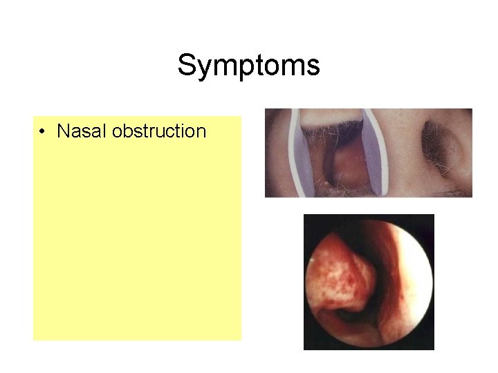 Symptoms • Nasal obstruction  Symptoms • Nasal obstruction