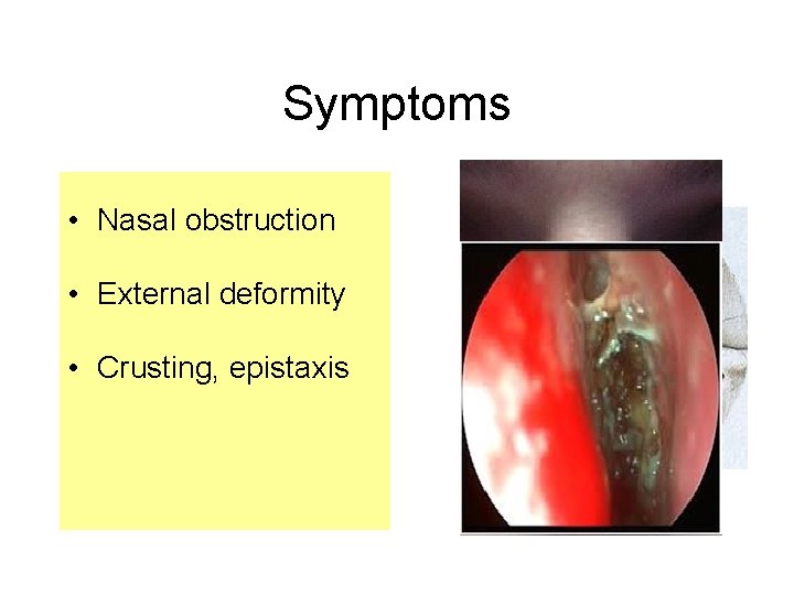 Symptoms • Nasal obstruction • External deformity • Crusting, epistaxis  Symptoms • Nasal obstruction • External deformity • Crusting, epistaxis
