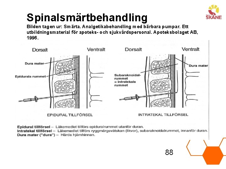 Spinalsmärtbehandling Bilden tagen ur: Smärta. Analgetikabehandling med bärbara pumpar. Ett utbildningsmaterial för apoteks- och