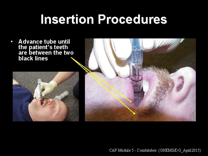 Insertion Procedures • Advance tube until the patient’s teeth are between the two black