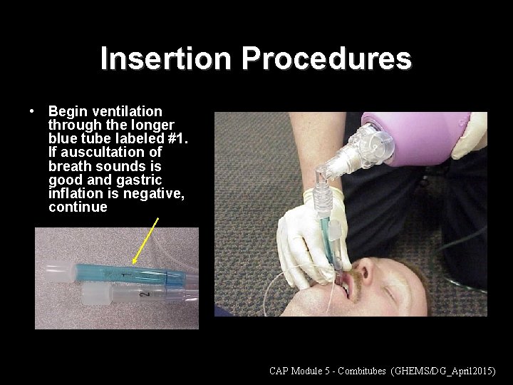 Insertion Procedures • Begin ventilation through the longer blue tube labeled #1. If auscultation