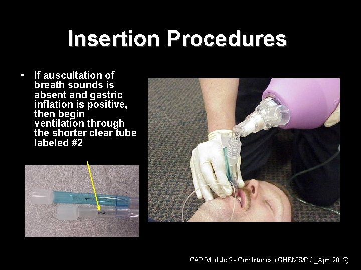 Insertion Procedures • If auscultation of breath sounds is absent and gastric inflation is