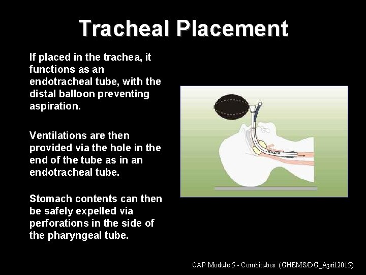 Tracheal Placement If placed in the trachea, it functions as an endotracheal tube, with