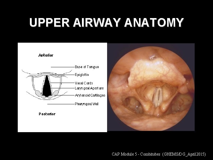 UPPER AIRWAY ANATOMY CAP Module 5 - Combitubes (GHEMS/DG_April 2015) 