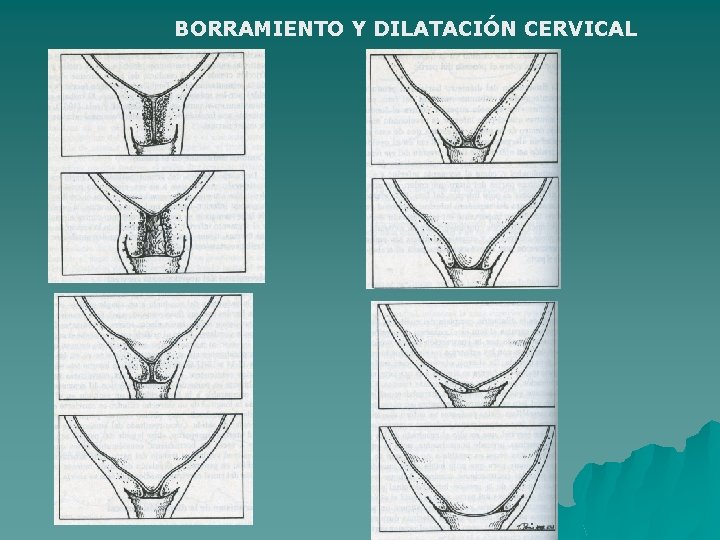 BORRAMIENTO Y DILATACIÓN CERVICAL 