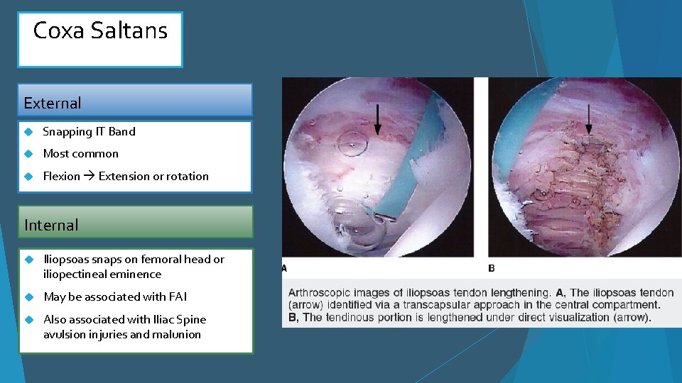 Coxa Saltans External Snapping IT Band Most common Flexion Extension or rotation Internal Iliopsoas