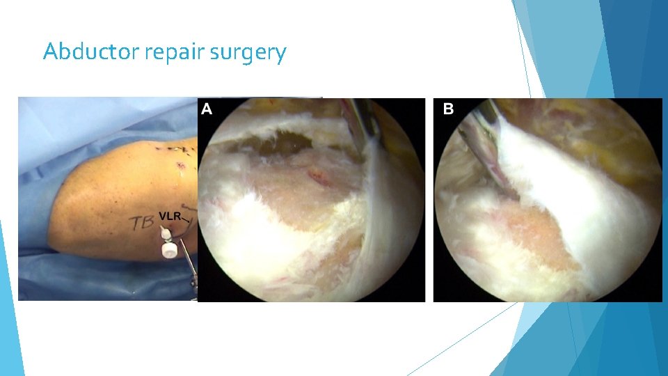 Abductor repair surgery 