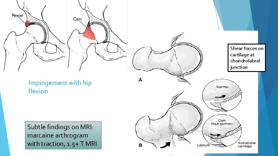 Shear forces on cartilage at chondrolabral junction Impingement with hip flexion Subtle findings on