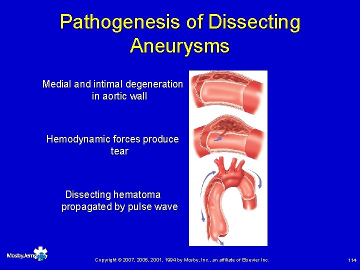 Pathogenesis of Dissecting Aneurysms Medial and intimal degeneration in aortic wall Hemodynamic forces produce