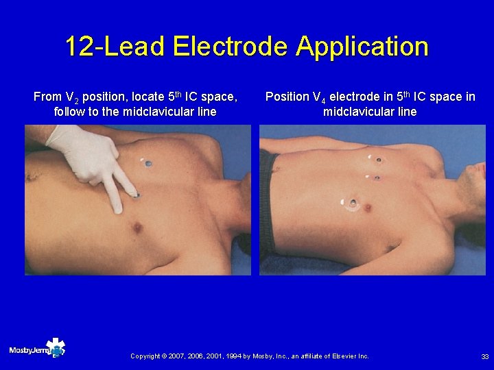 12 -Lead Electrode Application From V 2 position, locate 5 th IC space, follow