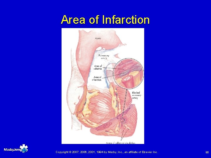Area of Infarction Copyright © 2007, 2006, 2001, 1994 by Mosby, Inc. , an