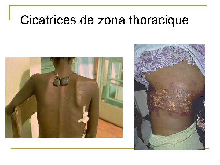 Cicatrices de zona thoracique 