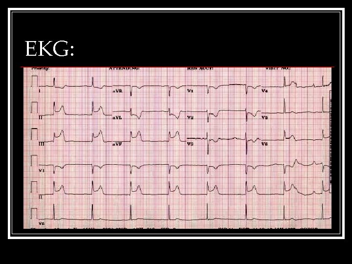 EKG: 