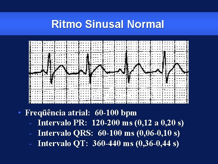 Ritmo Sinusal Normal • Freqüência atrial: 60 -100 bpm - Intervalo PR: 120 -200