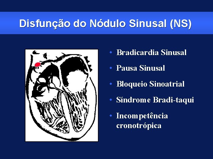 Disfunção do Nódulo Sinusal (NS) • Bradicardia Sinusal • Pausa Sinusal • Bloqueio Sinoatrial