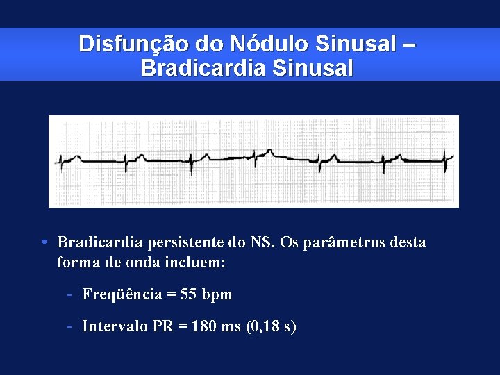 Disfunção do Nódulo Sinusal – Bradicardia Sinusal • Bradicardia persistente do NS. Os parâmetros