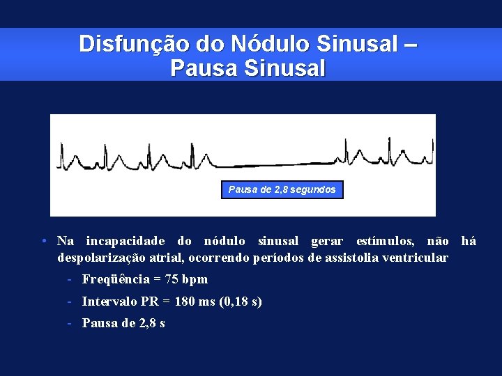 Disfunção do Nódulo Sinusal – Pausa Sinusal Pausa de 2, 8 segundos • Na