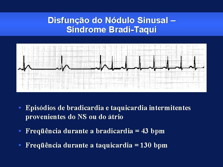 Disfunção do Nódulo Sinusal – Síndrome Bradi-Taqui • Episódios de bradicardia e taquicardia intermitentes