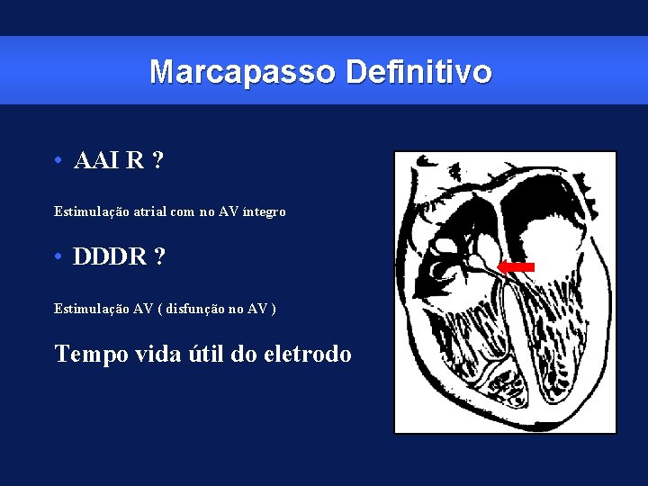 Marcapasso Definitivo • AAI R ? Estimulação atrial com no AV íntegro • DDDR