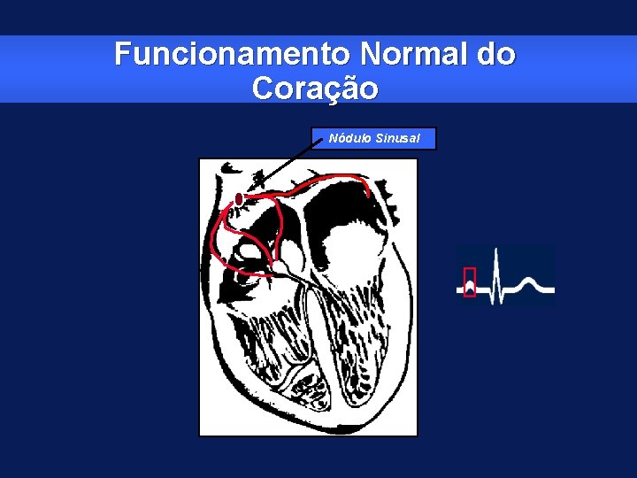 Funcionamento Normal do Coração Nódulo Sinusal 