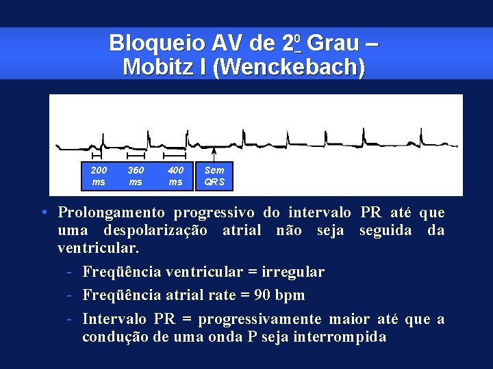 Bloqueio AV de 20 Grau – Mobitz I (Wenckebach) 200 ms 360 ms 400