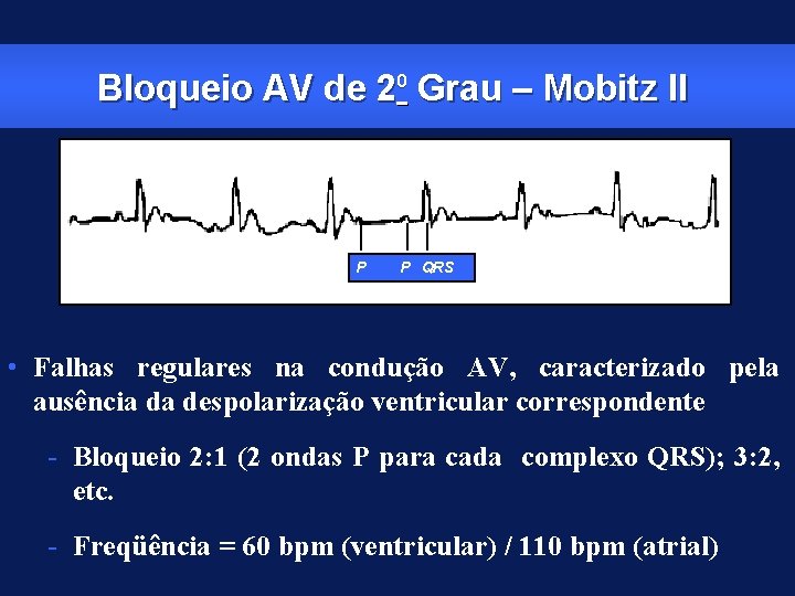 Bloqueio AV de 20 Grau – Mobitz II P P QRS • Falhas regulares