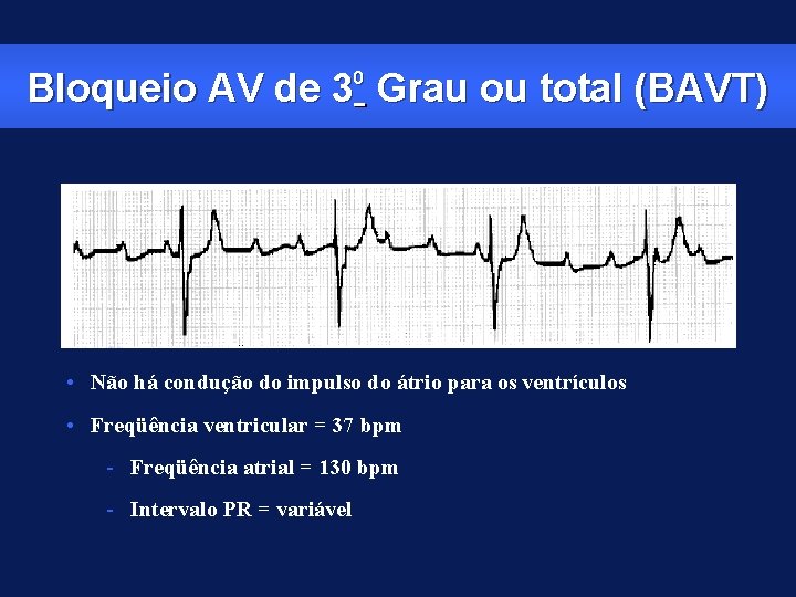 Bloqueio AV de 30 Grau ou total (BAVT) • Não há condução do impulso