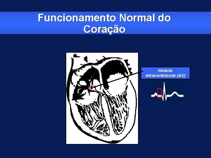 Funcionamento Normal do Coração Nódulo Atrioventricular (AV) 