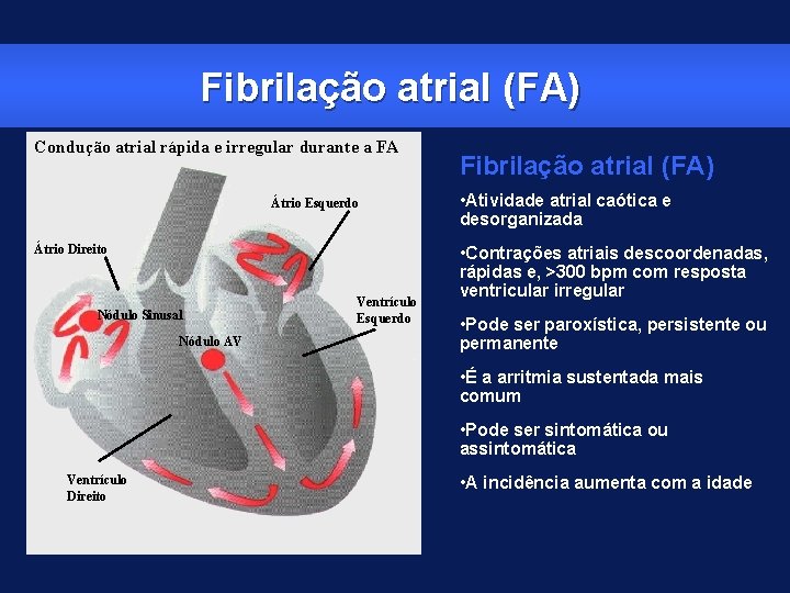 Fibrilação atrial (FA) Condução atrial rápida e irregular durante a FA Átrio Esquerdo Átrio