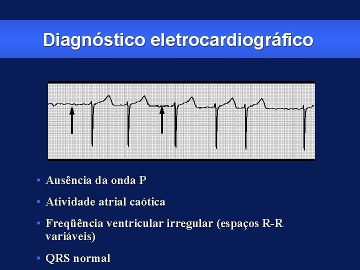 Diagnóstico eletrocardiográfico • Ausência da onda P • Atividade atrial caótica • Freqüência ventricular