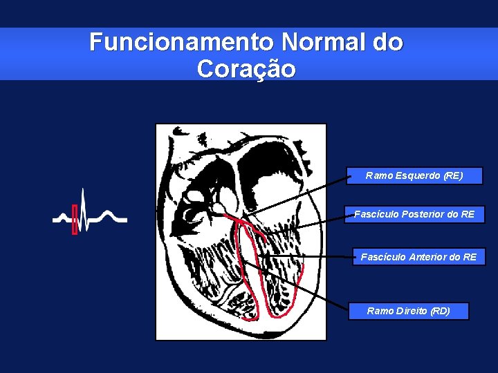 Funcionamento Normal do Coração Ramo Esquerdo (RE) Fascículo Posterior do RE Fascículo Anterior do