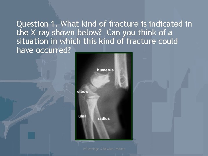 Question 1. What kind of fracture is indicated in the X-ray shown below? Can