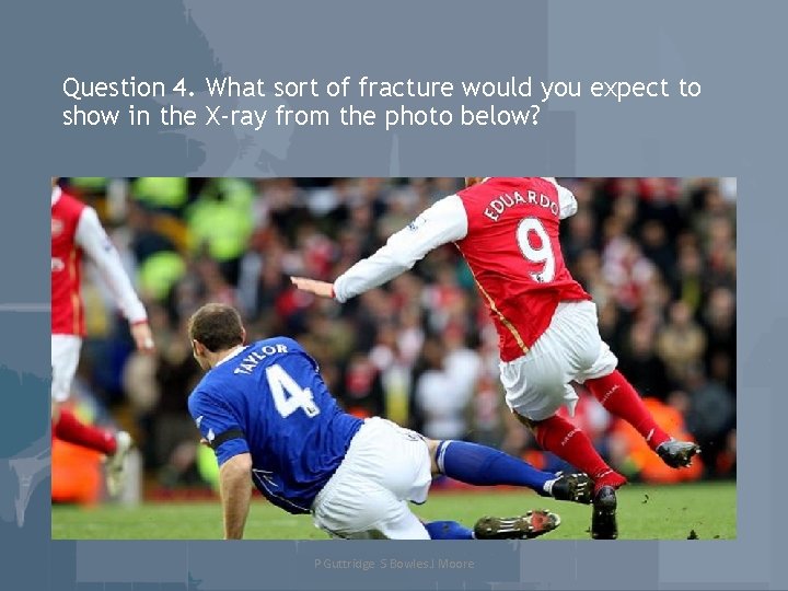 Question 4. What sort of fracture would you expect to show in the X-ray