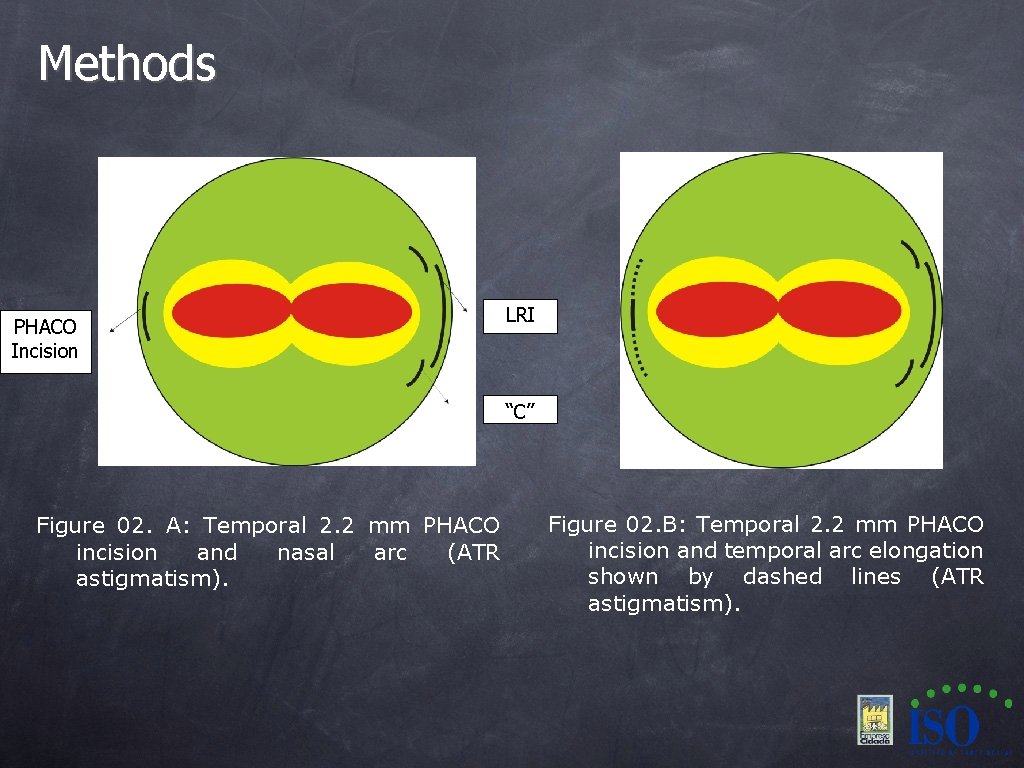 Methods PHACO Incision LRI “C” Figure 02. A: Temporal 2. 2 mm PHACO incision