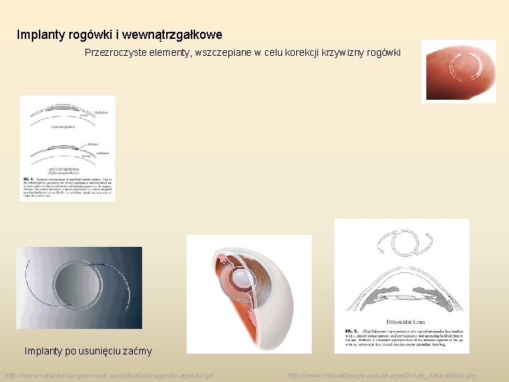 Implanty rogówki i wewnątrzgałkowe Przezroczyste elementy, wszczepiane w celu korekcji krzywizny rogówki Implanty po