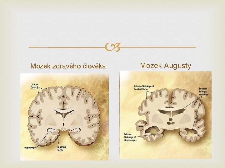  Mozek zdravého člověka Mozek Augusty 