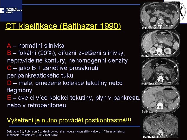 CT klasifikace (Balthazar 1990) A – normální slinivka B – fokální (20%), difuzní zvětšení