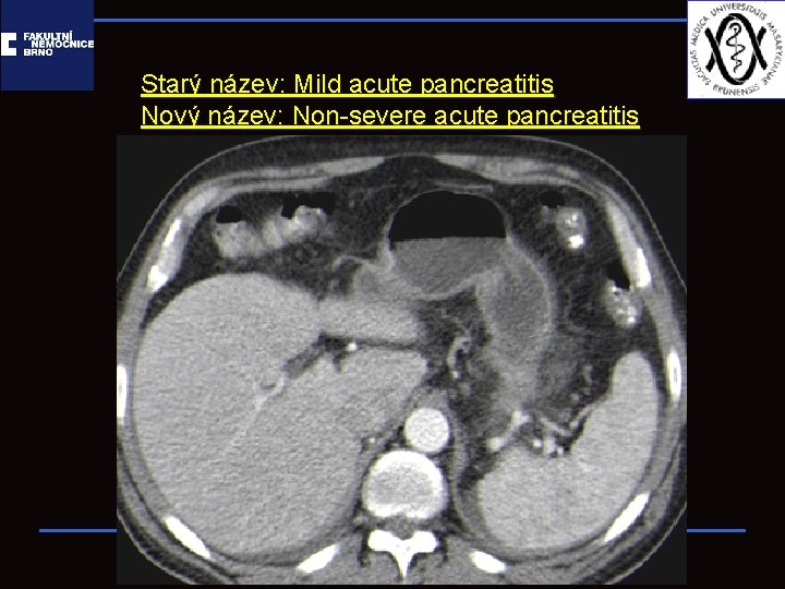 Starý název: Mild acute pancreatitis Nový název: Non-severe acute pancreatitis 