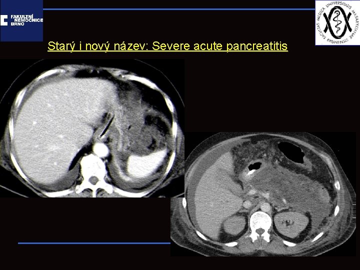 Starý i nový název: Severe acute pancreatitis 