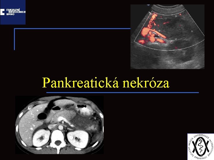 Pankreatická nekróza 