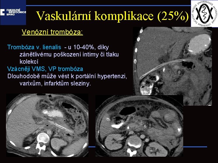 Vaskulární komplikace (25%) Venózní trombóza: Trombóza v. lienalis - u 10 -40%, díky zánětlivému