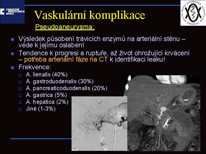 Vaskulární komplikace Pseudoaneurysma: n n n Výsledek působení trávicích enzymů na arteriální stěnu –
