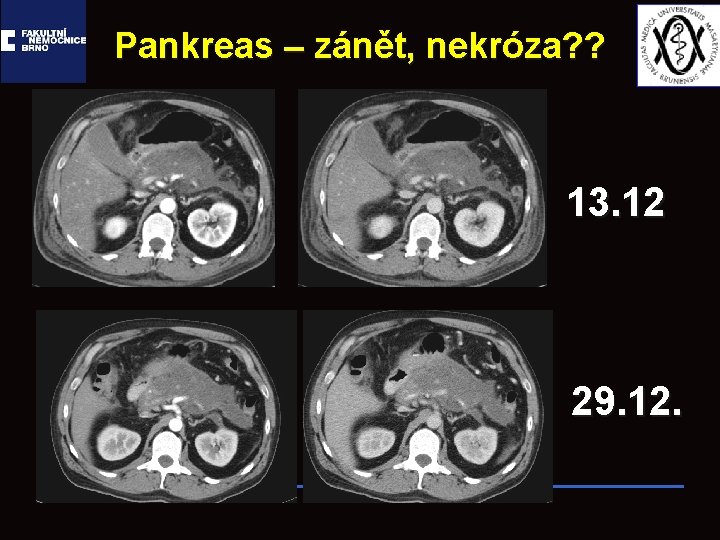 Pankreas – zánět, nekróza? ? 13. 12 29. 12. 