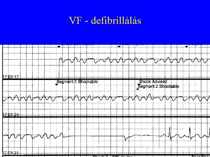 VF - defibrillálás GŐBL 2002 