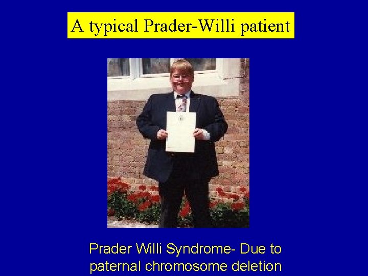 A typical Prader-Willi patient Prader Willi Syndrome- Due to paternal chromosome deletion 